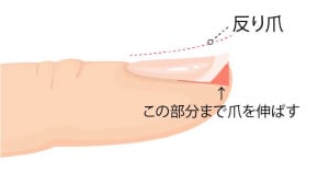 上記のように爪を整えてしまった場合は、爪溝と側爪郭全体をしっかりと爪を伸ばすることで改善されることがあります。爪溝と側爪郭の部分全体までしっかりと伸ばしたうえで、お好きなフォルムに整えるようにしましょう