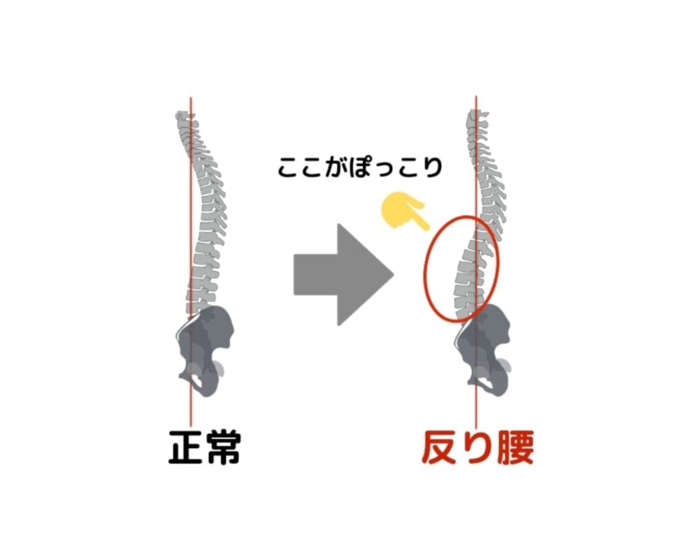 例えば、お尻の筋肉が弱くなることで骨盤が前側に引っ張られ倒れてしまうと、"反り腰"という姿勢になってしまいます。反り腰になると、イラストのようにお腹がぽっこりと前に出てきてしまいます