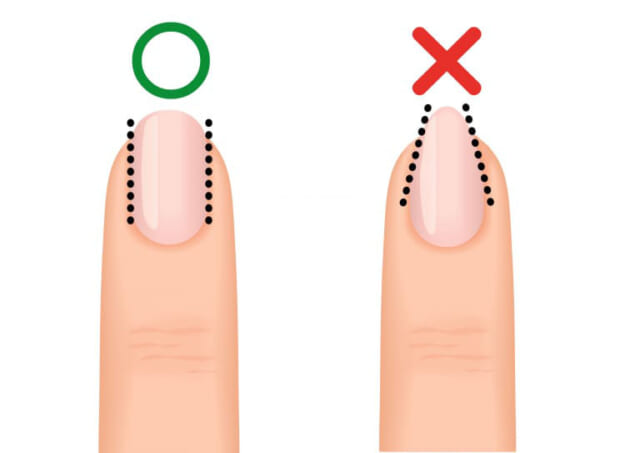 爪を整える際によくやりがちなのが、指先を細く見せたいからといって図の右側の爪のように、爪溝と側爪郭の途中から内側に切り込んでしまうことです